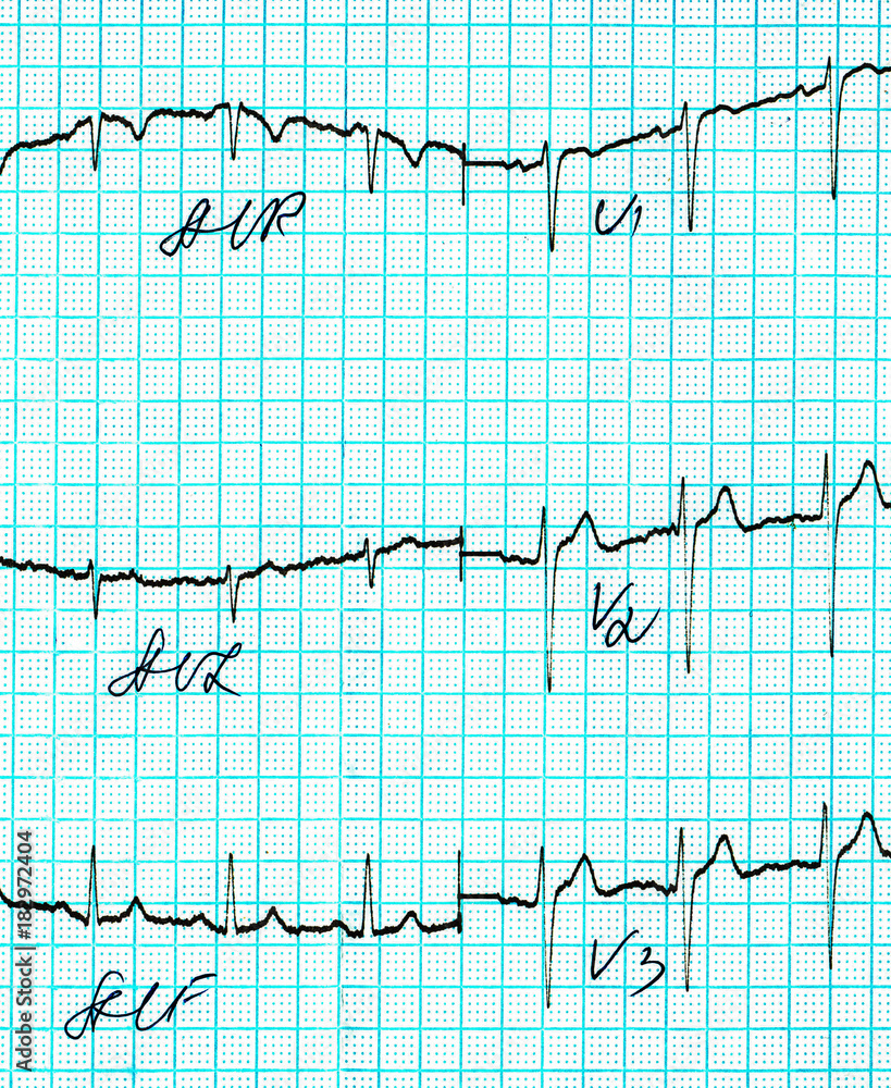 Cardiogramm picture. Fragment Cardiogramm picture. Fragment