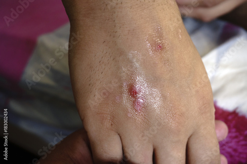 Slika na platnu allergic rash dermatitis skin of patient