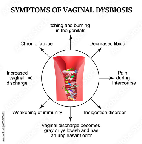 Symptoms of vaginal dysbiosis. Vaginitis, candidiasis. Patagene microflora of the vagina. Dysbacteriosis. Infographics. Vector illustration on isolated background.