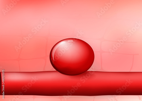 artery with an aneurysm on red background