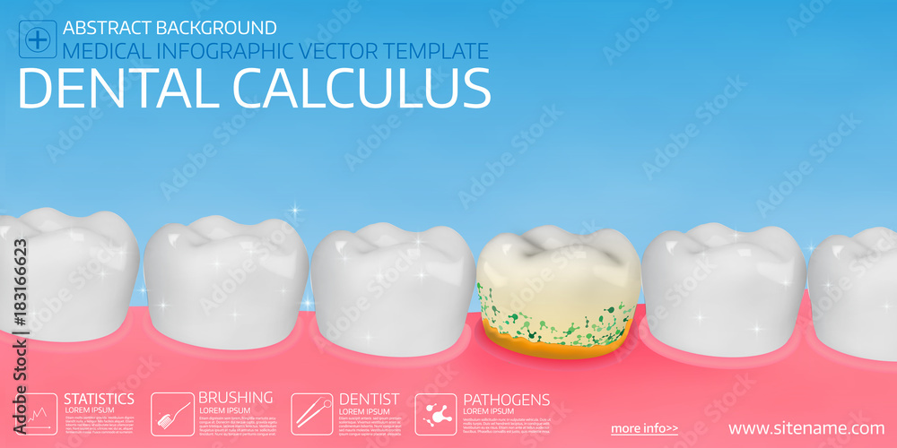 Obraz premium Dental calculus horisontal medical banner template.