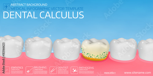 Dental calculus horisontal medical banner template.