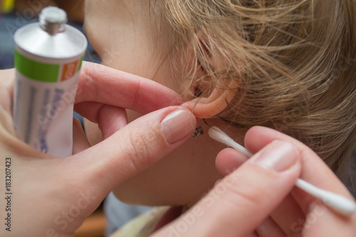 a little girl is treated with a wound on the earlobe after earring piercing