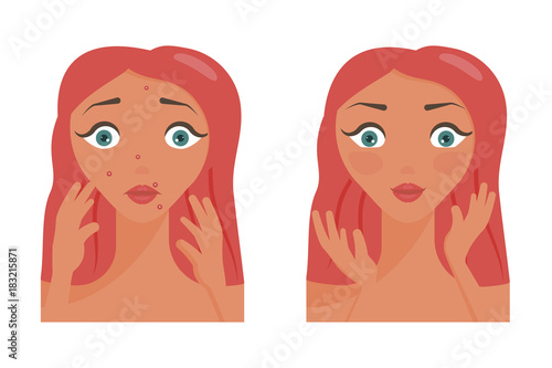 Poster of acne pimples.