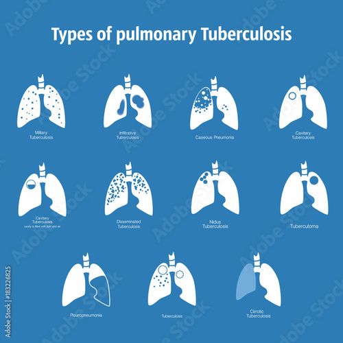 Types of tuberculosis. Vector silhouette medical illustration of human body organ - lungs with trachea. Poster for clinic, hospital. Respiratory system