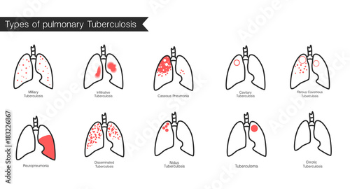Types of tuberculosis. Vector silhouette medical illustration of human body organ - lungs with trachea. Poster for clinic, hospital. Respiratory system