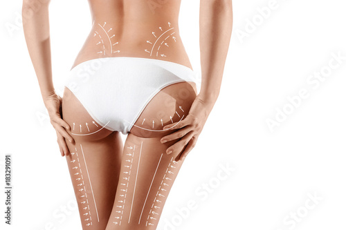 Female body with patterned lines and arrows on it, isolated on white. The concept of plastic surgery, fat removal, liposuction and cellulite.