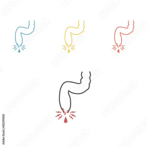 vector illustration of a prolapsed hemorrhoid veins