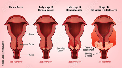 Cervical cancer image