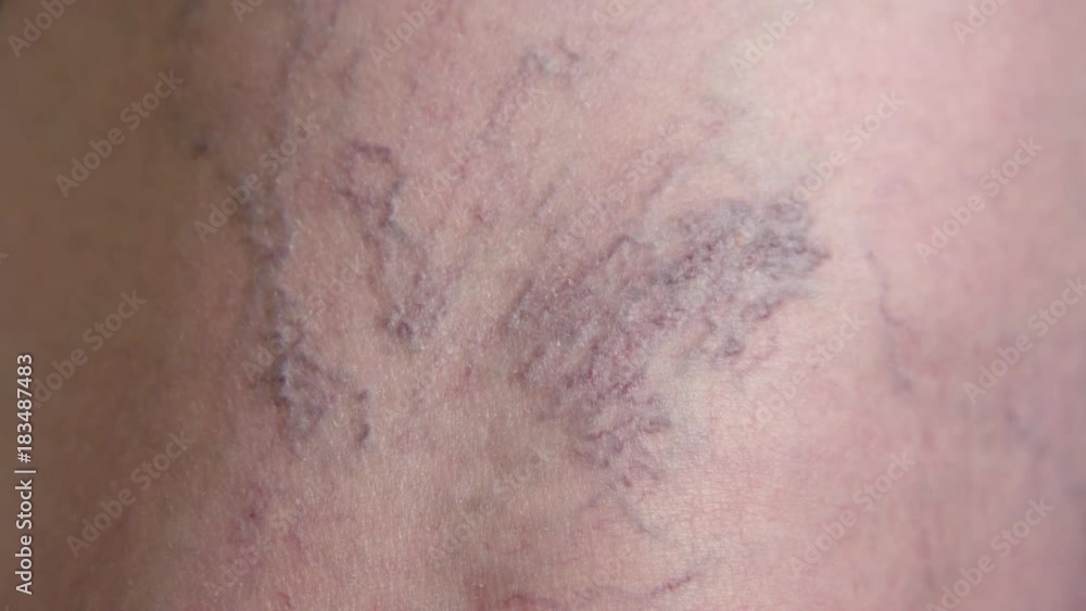 SLOW MOTION MACRO: Purplish hued blue varicose veins on back of knee of a senior woman. Close up view of lady's problematic veins at doctor's office before treatment. Examination of leg blood vessels. SLOW MOTION MACRO: Purplish hued blue varicose veins on back of knee of a senior woman. Close up view of lady's problematic veins at doctor's office before treatment. Examination of leg blood vessels.