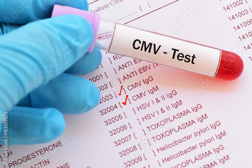 Blood sample with requisition form for cytomegalovirus (CMV) test
 photo