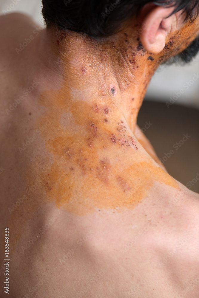 shingles on skin shingles on skin