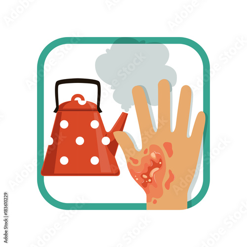 Illustration showing third degree burn of hand. Severe burns skin from kettle. Thermal injury. Flat vector design element for card, brochure or poster