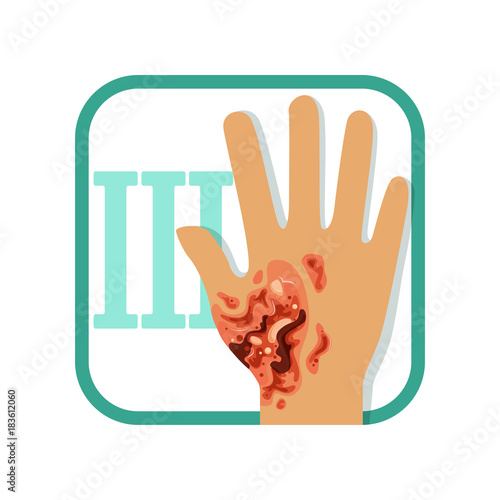 Third degree of burn. Hand with damaged outer (epidermis) and inner (dermis) layer of skin. Severe injury. Flat vector design for medicine book, poster or flyer