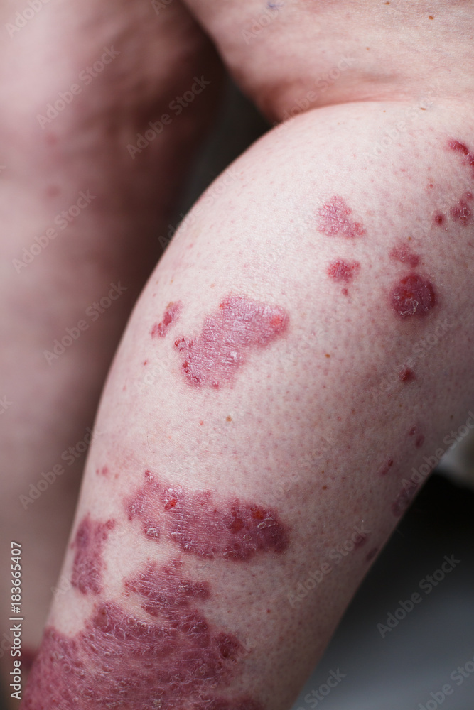 Allergic rash dermatitis eczema skin on leg of patient. Psoriasis and eczema skin with big red spots Allergic rash dermatitis eczema skin on leg of patient. Psoriasis and eczema skin with big red spots
