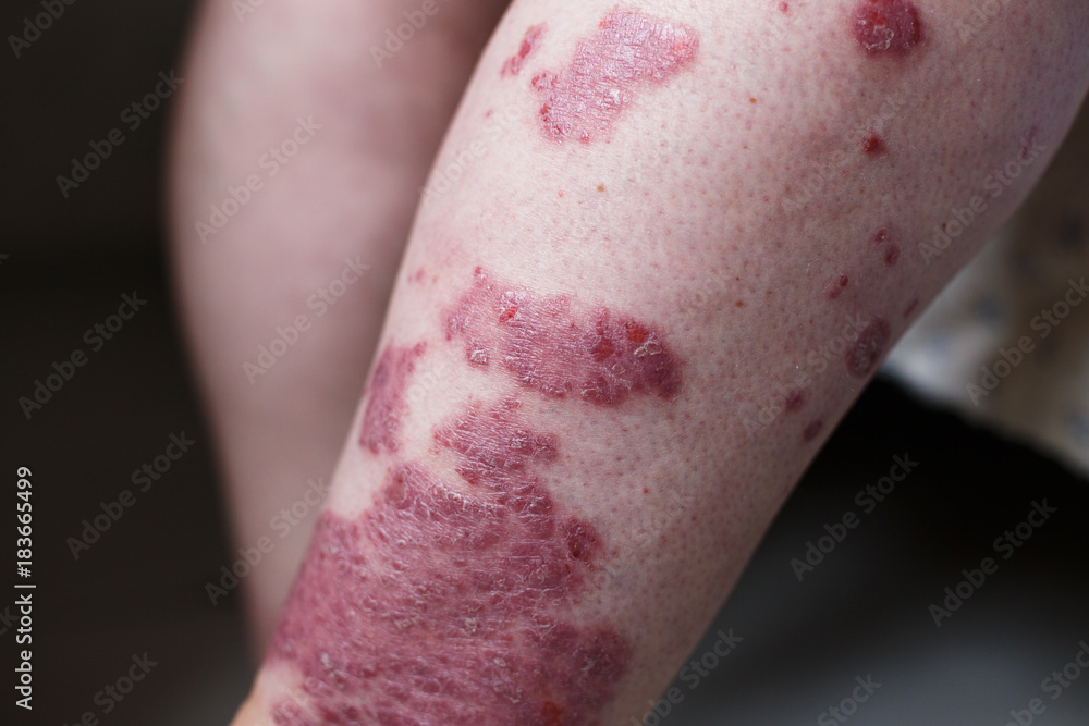 Allergic rash dermatitis eczema skin on leg of patient. and eczema with big red spots Stock Photo | Adobe Stock