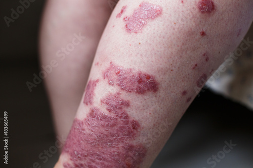 Allergic rash dermatitis eczema skin on leg of patient. Psoriasis and eczema skin with big red spots