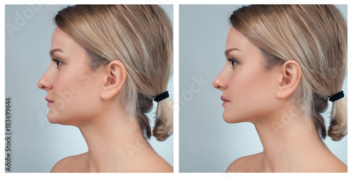 Portrait of female face  before and after rhinoplasty