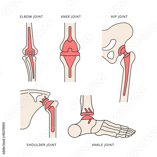 implantation joint skeleton