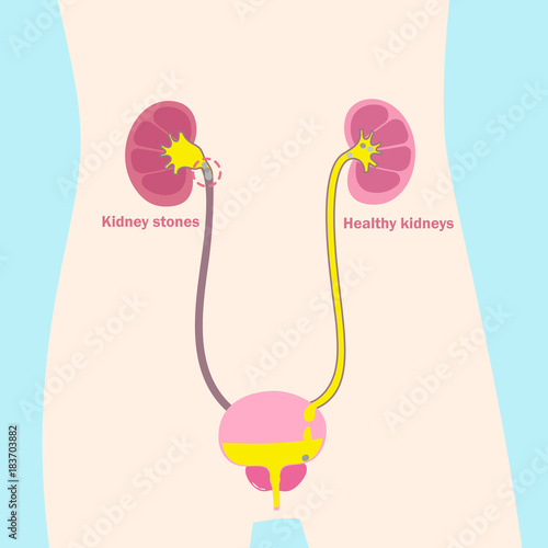 kidney with healthy problem