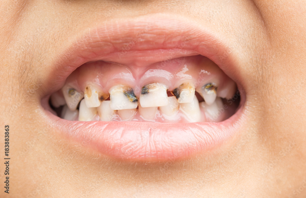 Broken teeth in children Stock Photo Adobe Stock