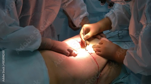 Abdominal liposuction. Partial removal of fat and mucous tissues of the abdomen.