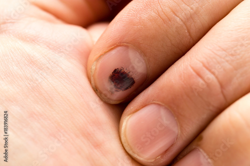 A finger bruised with a hammer