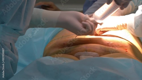 Close-up Of Surgeon Hands Drawing Correction Lines On Woman Stomach