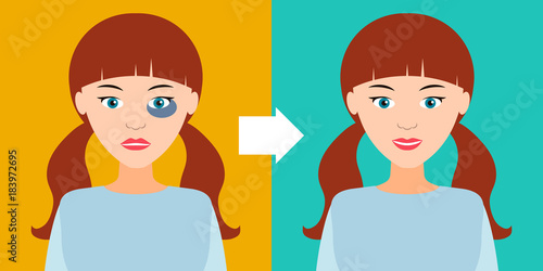 Beautiful girl with a bruise and without. Vector illustration.