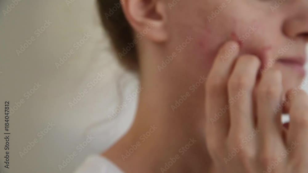 Beautiful young brunette girl crushes white and red pimples and acne on her face on a white background Beautiful young brunette girl crushes white and red pimples and acne on her face on a white background