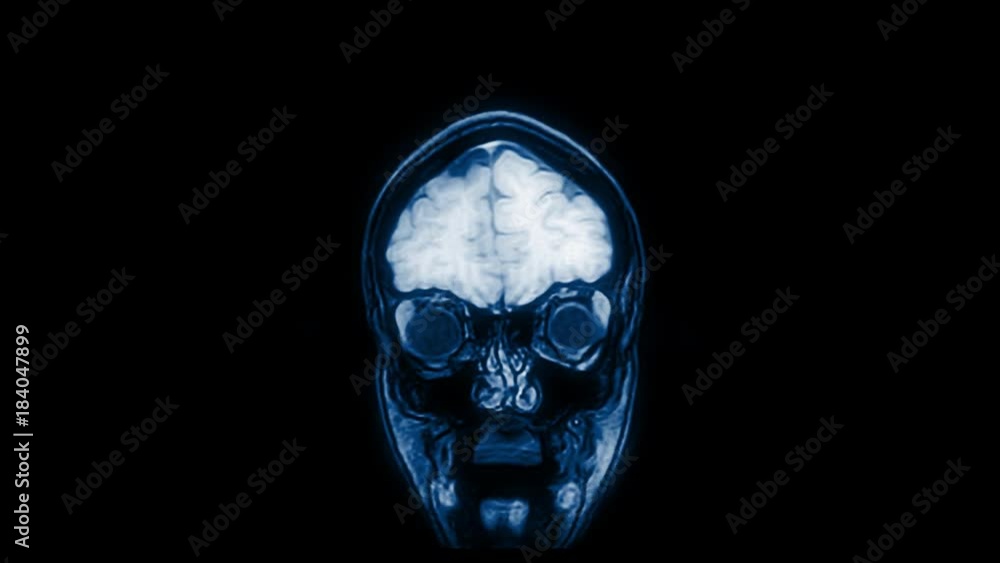 Computed medical tomography MRI upscaled scan of healthy young female head. Front view. Discrete slices. Blue/teal on black background. Computed medical tomography MRI upscaled scan of healthy young female head. Front view. Discrete slices. Blue/teal on black background.