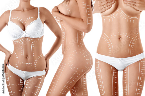 Female body with patterned lines and arrows on it, isolated on white. The concept of plastic surgery, fat removal, liposuction and cellulite. photo