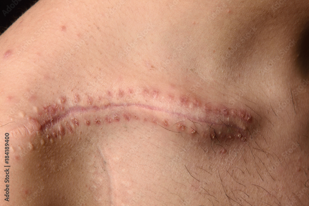 Fototapeta premium detail of a scar on the clavicle
