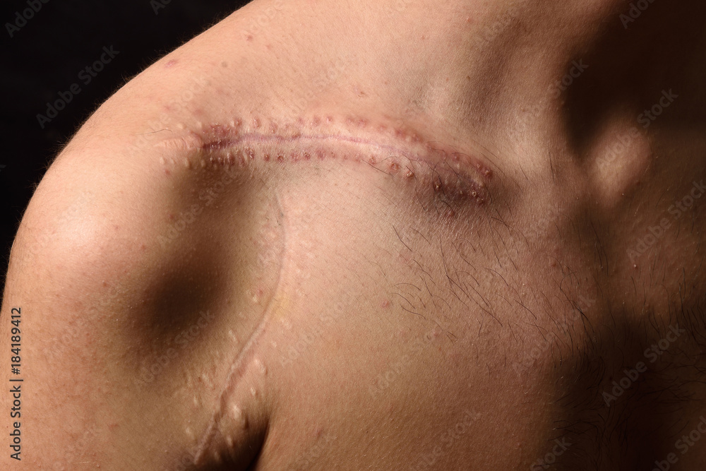 detail of a scar on the clavicle detail of a scar on the clavicle