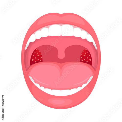 vector illustration of a throat bacterial and viral infection, tonsils inflammation.