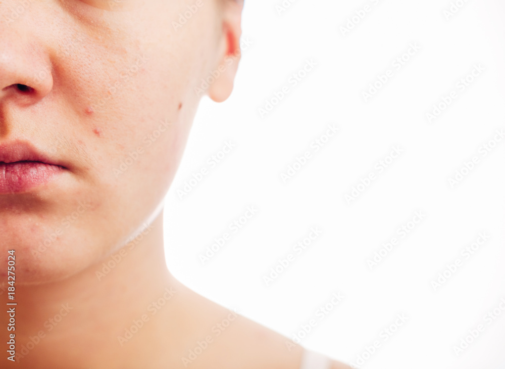 Obraz premium skin defects on the face of a girl, pimples on the face of a girl