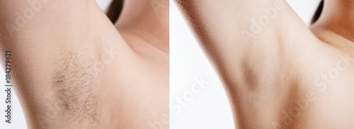 Woman with armpit hair, female hairy armpit, clean woman armpit, before and after shaving photo