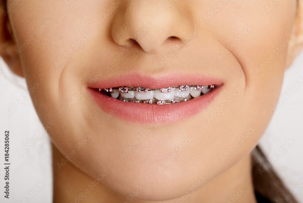 Fototapeta premium Close up teeth of smiling teen woman with dental braces.