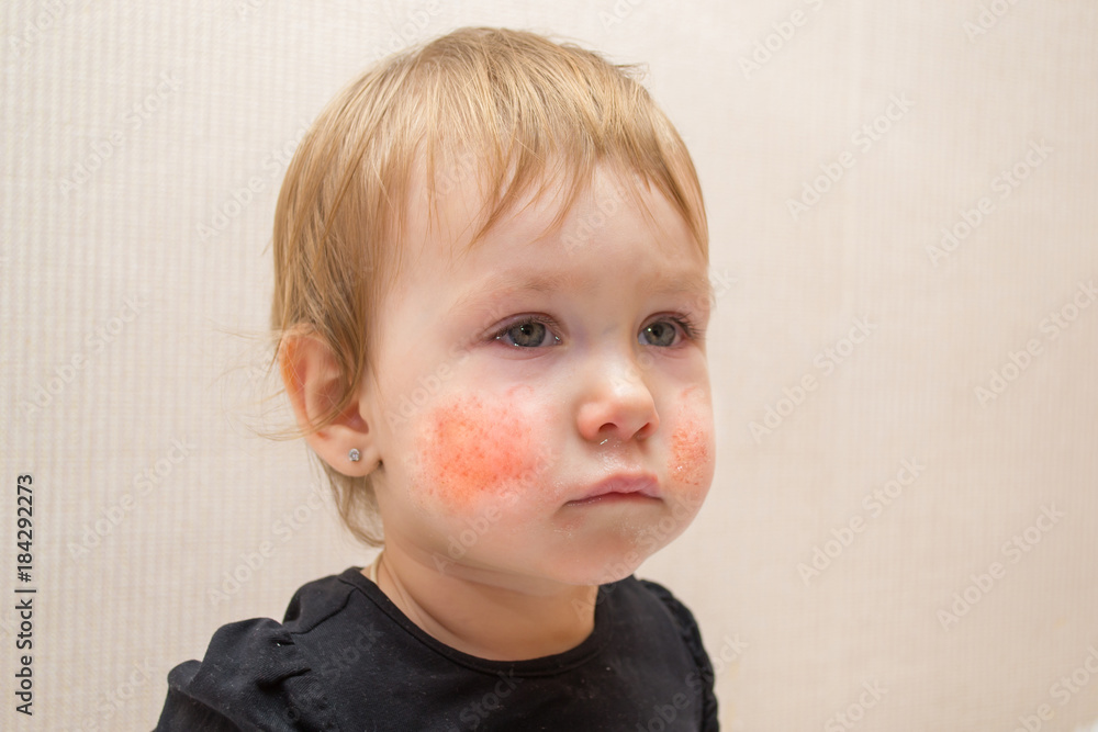 Cute child 1 2 years old with eczema or allergic rash on his face