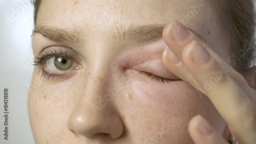 Woman with allergic reaction touching eye photo