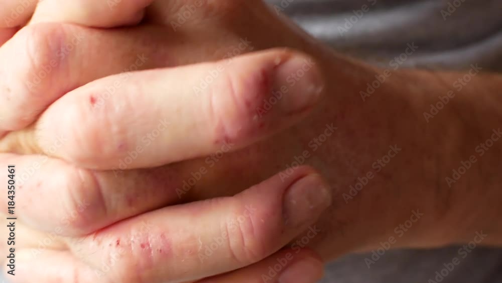 A man with eczema-affected hands. Male hands close-up A man with eczema-affected hands. Male hands close-up