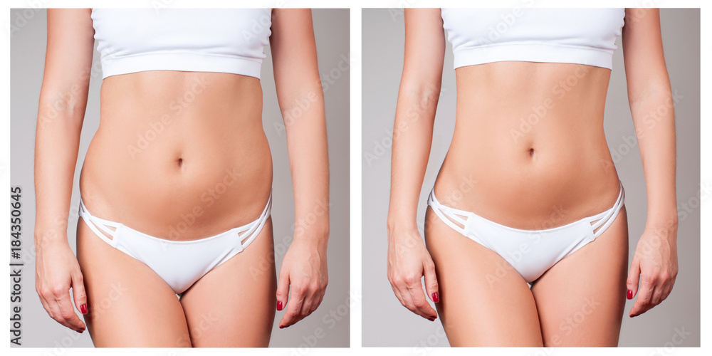 Female body before and after treatment. Plastic surgery. Stock Photo