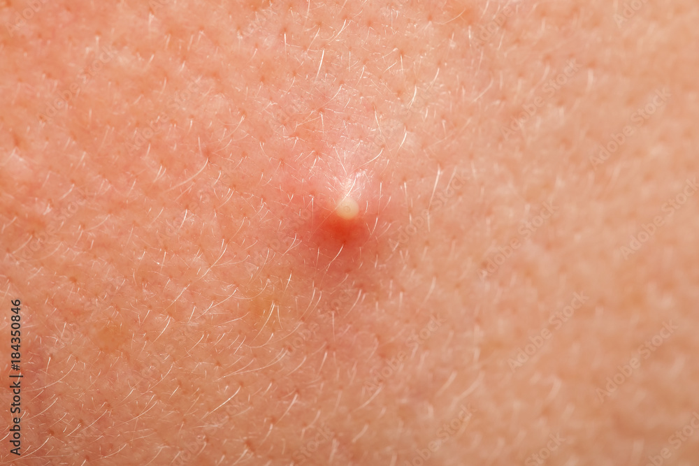 Fototapeta premium The inflamed facial acne, close up.