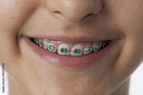 Close up of dental braces in the mouth of a teenage girl