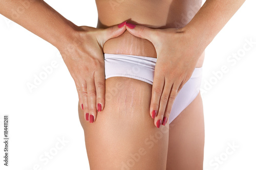 Woman examining her stretch marks photo