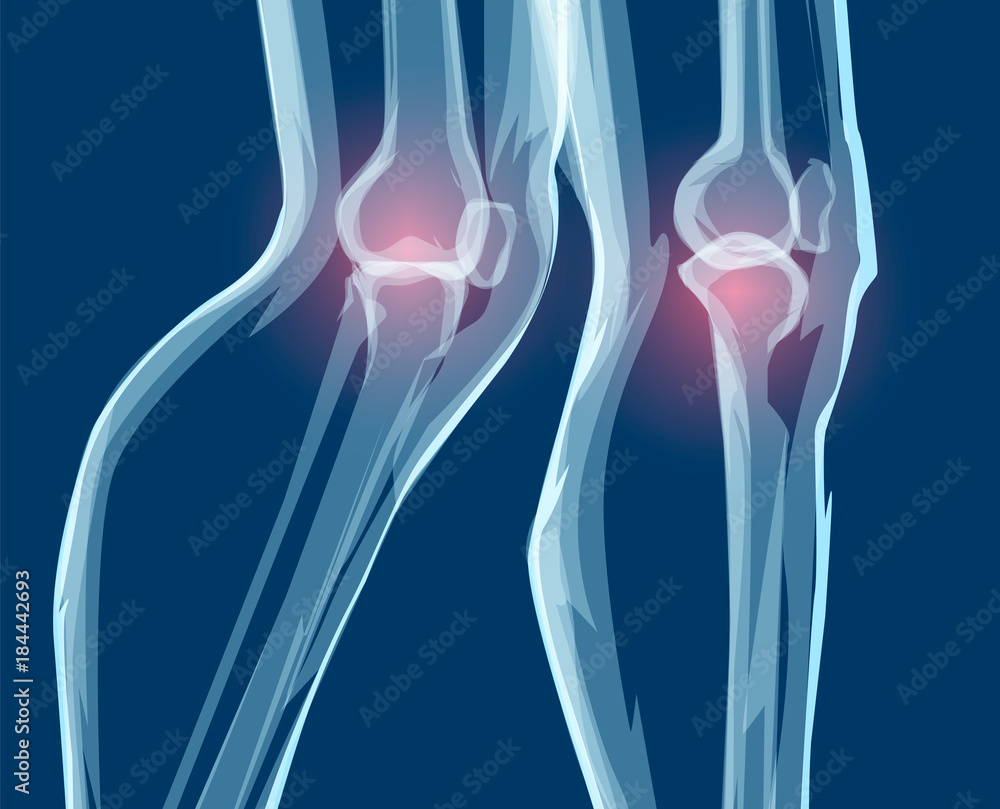Human leg bones, x-rays. Mecial vector illustration. Human leg bones, x-rays. Mecial vector illustration.