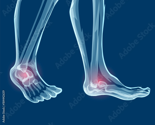 Human leg bones, x-rays. Mecial vector illustration.