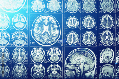 Photos Computer head tomography, X-Ray brain or scull scan image, blue light effect, ne