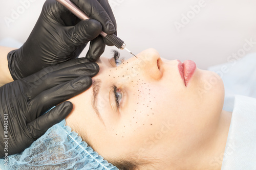 Permanent microblasting tattooing freckles to a woman in a beauty salon photo