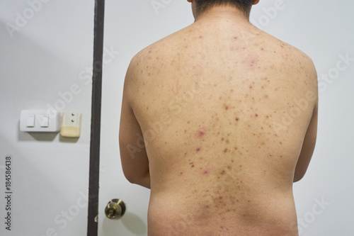 Man with acne, with red spots on the back isolated on white background